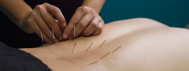 Manualna terapija in masaže Bruno Modno frizerstvo Frizerski salon Yvonne Dry Needling 4