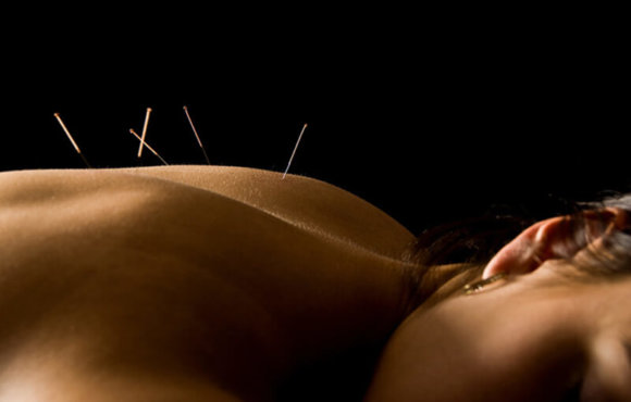 Dry Needling